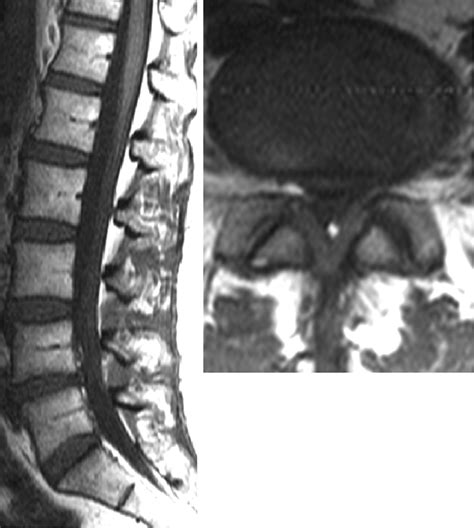 Ligamentum Flavum Hypertrophy Mri