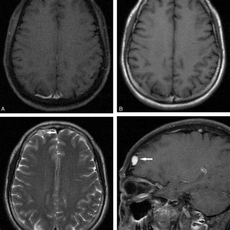 Preoperative Magnetic Resonance Images Postcontrast Images Revealed A
