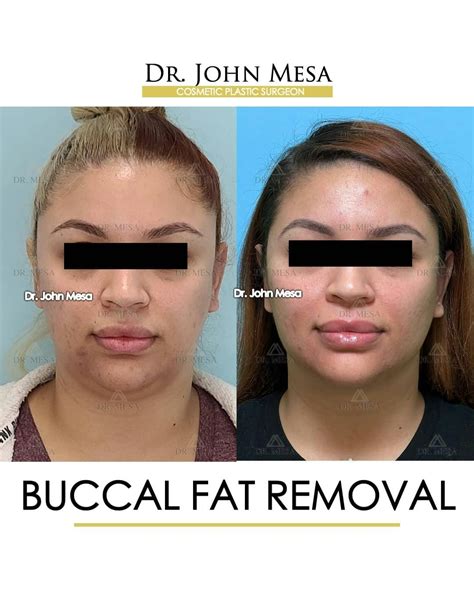 Buccal Fat Pad Removal Gallery