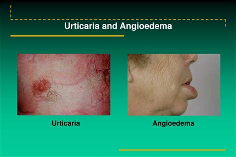 Ppt Urticaria And Angioedema Powerpoint Presentation Free Download