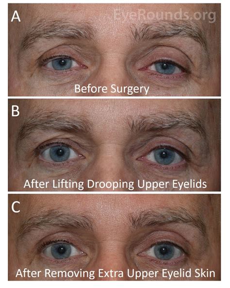 atlas entry cosmetic correction of secondary upper eyelid dermatochalasis after upper eyelid