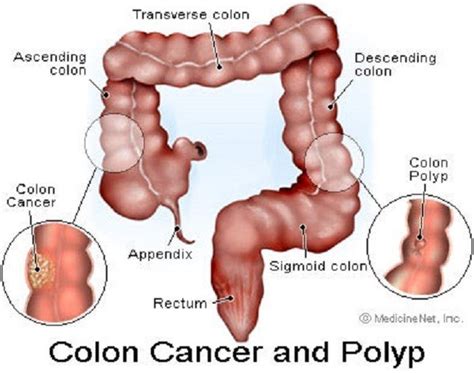 Táo bón hay chảy máu trực tràng là những triệu chứng ung thư đại tràng phổ biến nhất. Cắt polyp trực tràng ở đâu?Tại Bệnh viện Thu Cúc