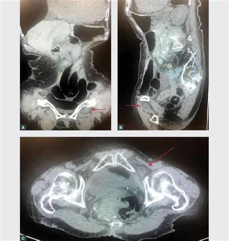 Racgp Obturator Hernia As A Cause Of Small Bowel Obstruction