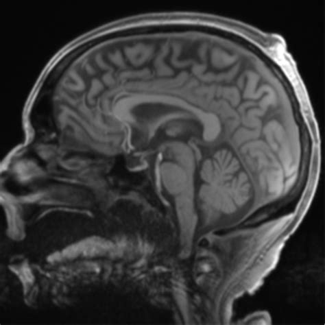 Cns Aspergillosis Image