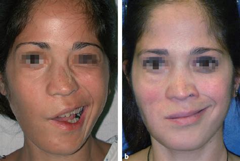 Facial Reanimation Surgery Plastic Surgery Key