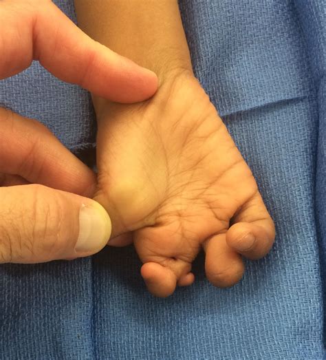 Amniotic Constriction Band Congenital Hand And Arm Differences