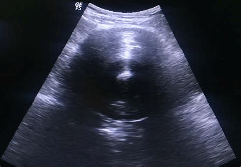 Sonographic Image Showing A Large Predominantly Hypoechoic Lesion With