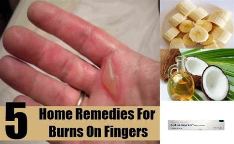 5 Home Remedies For Burns