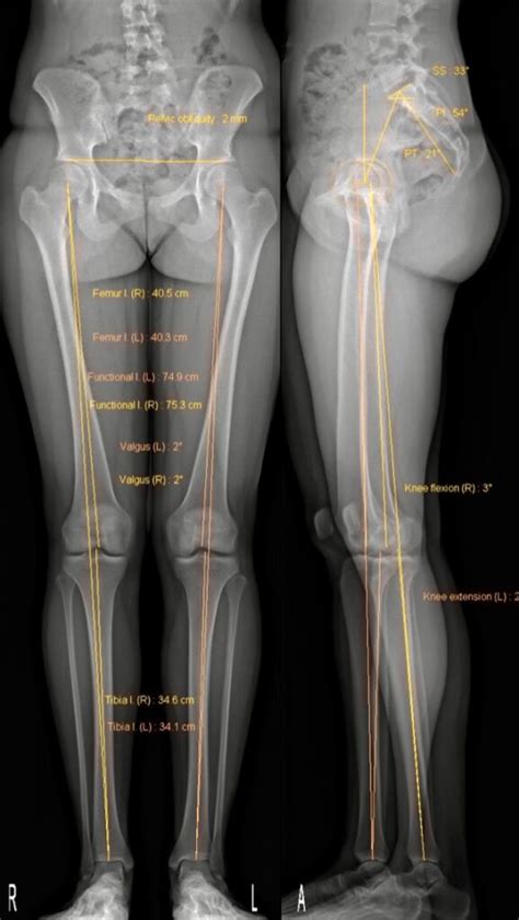 IMAGING GUIDED EUFLEXXA INJECTION FOR MANAGEMENT OF KNEE OSTEOARTHRITIS