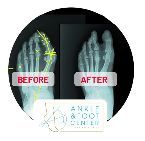 Minimally Invasive Foot Surgery Ankle And Foot Center Of Central Florida