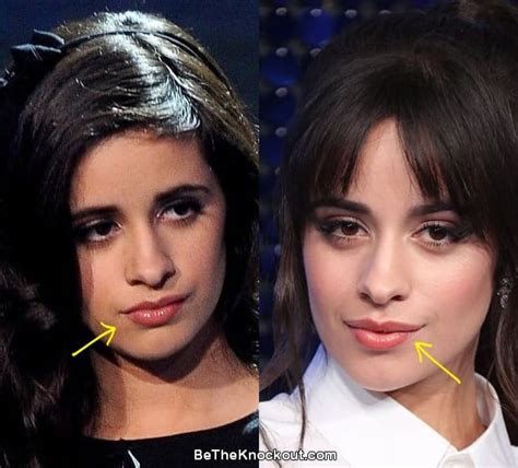 Camila Cabello Plastic Surgery Comparison Photos Hot Sex Picture