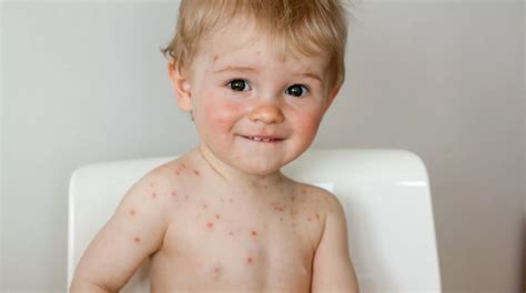 Chicken Pox Rash In Children And Adults What It Looks Like At What
