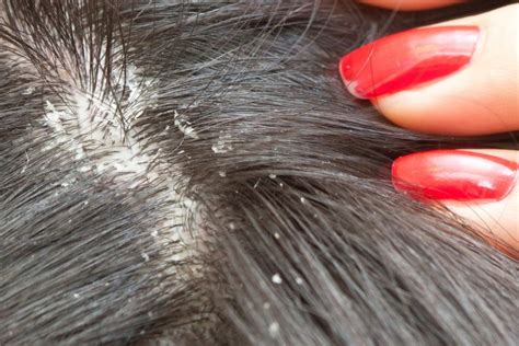 (the hair should not be dry or completely wet). How to Get Rid of Dry Scalp | GetRidofThings.com
