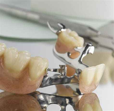 national dentex partial dental dentures