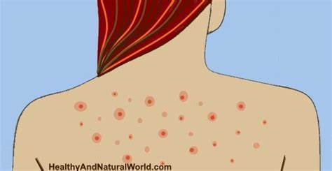 Heres How To Get Rid Of Back Acne Bacne Back Acne Treatment
