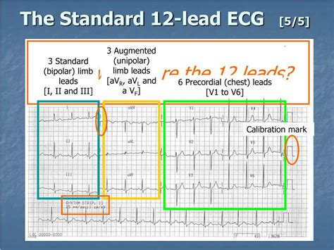 Ppt Introduction To The 12 Lead Ecg Powerpoint Presentation Free