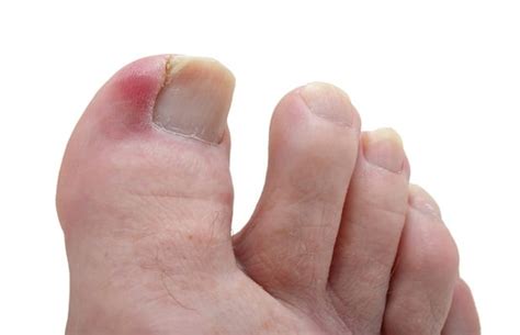 How To Spot Diabetic Foot Complications Early Life