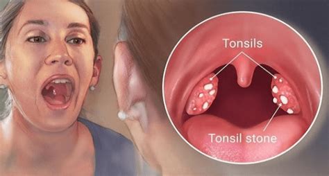 Tonsil Cure Surgery