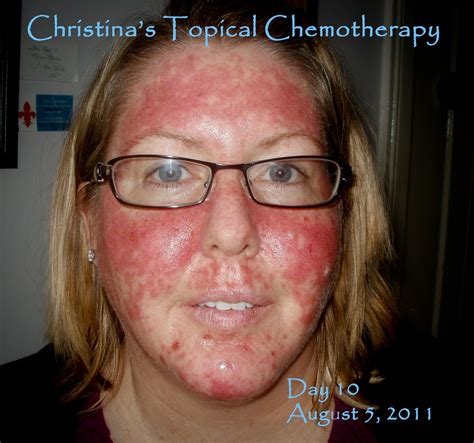 My Journey Through Topical Chemotherapy Fluorouracil 5 Cream And