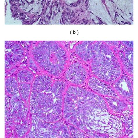 A Benign Mixed Tumor In Canine Mammary Gland Presenting Chondroid And