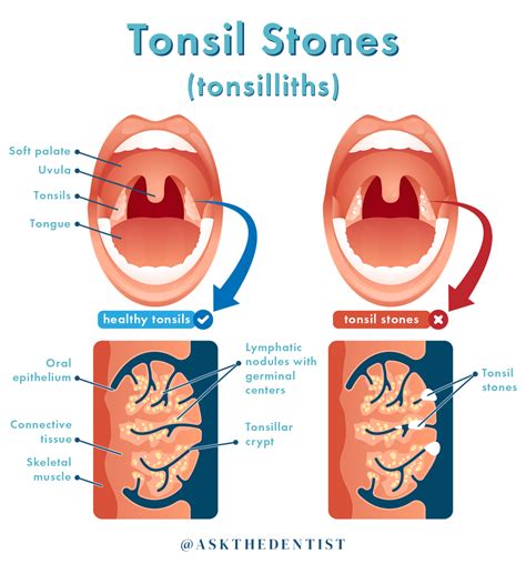 Dental Info Tonsil Stones Symptoms Causes And How To Remove