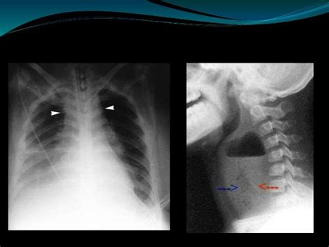 Surgical Treatment Of Paraphyrngeal And Retropharyngeal Abscesses