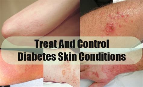 Diabetes And Your Skin Capestyle Magazine Online
