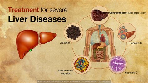 Treatment For Chronic Liver Disease Cures For Chronic Liver Disease