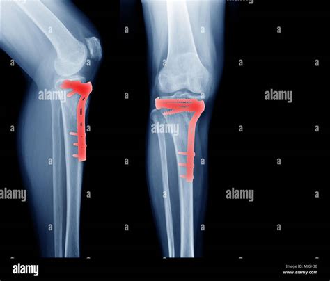 Internal Fixation Tibia Hi Res Stock Photography And Images Alamy