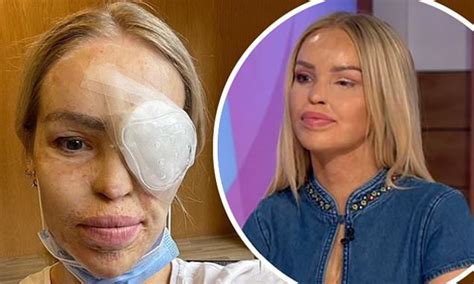 Katie Piper Reveals She Had Surgery To Close A Hole In Her Eye After