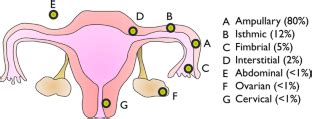 Non Tubal Ectopic Pregnancy Springerlink