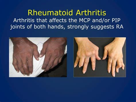 Ppt Rheumatoid Arthritis Update Powerpoint Presentation Free