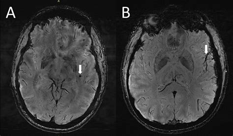 Ultra High Resolution Mri Reveals Migraine Brain Changes