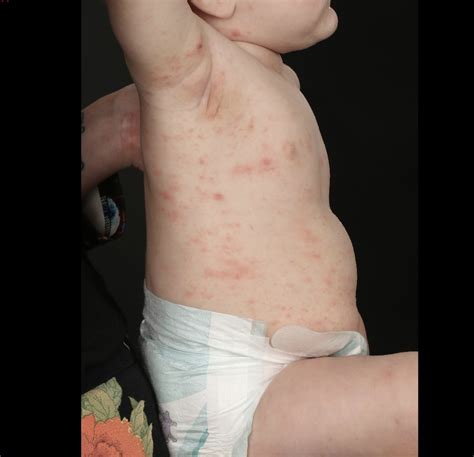 Covid Rash Toddler Coronavirus Symptoms In Kids Skin Symptoms That