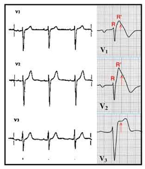 Saddleback st elevation is almost never stemi 2. Bangungut / Bangungot/ SUDS: The Folklore and the Science ...