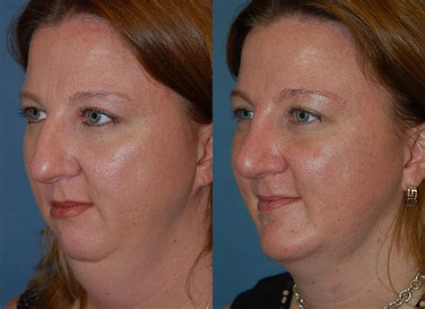 Laser Assisted Weekend Neck Lift Photos Melbourne Fl Patient 28454