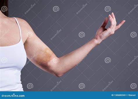 Bruises On The Woman`s Hands Arms With Extensive Hematoma Stock Image