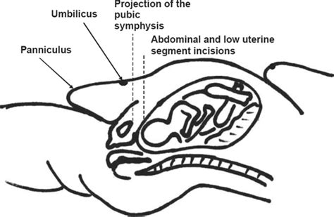 Cesarean Section In Morbidly Obese Women Supra Or Subumbilical