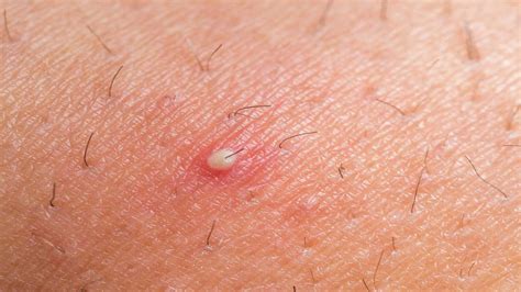Maybe you would like to learn more about one of these? How to Get Rid of Boils? - YouTube