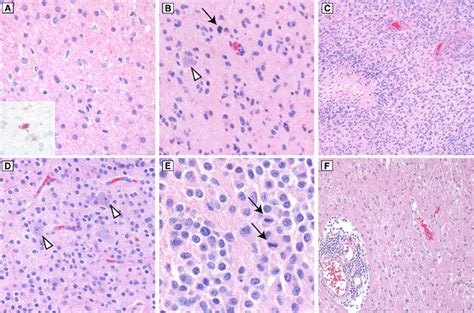 Typical Histologic Features Of Infiltrating Gliomas In Diffuse