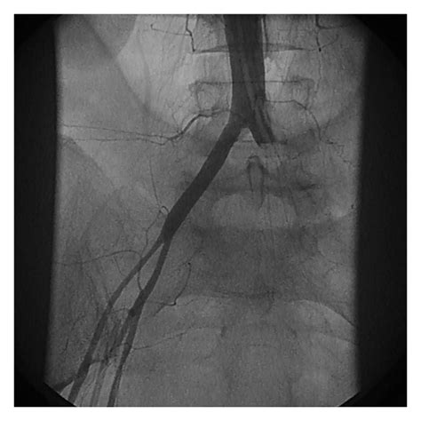 Common Femoral Artery Angiogram