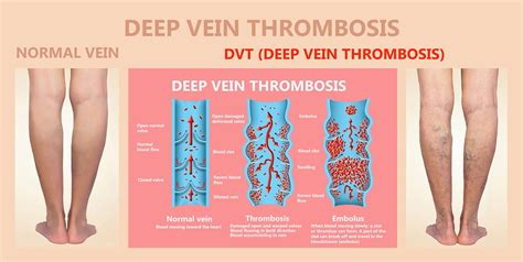 How Do You Know If You Have Deep Vein Thrombosis Dvt Vrogue Co