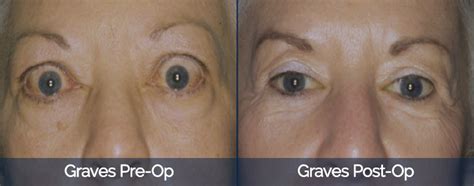 Cosmetic Before And After Gallery Florida Eye Specialists