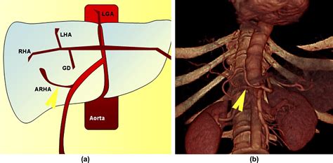 Multidetector Row Ct Angiography In The Evaluation Of The Hepatic