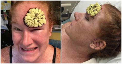 Womans Incredible Skin Cancer Photo Diary Shows The Reality Of Melanoma