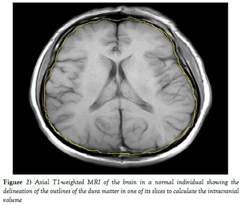 Hippocampus Brain Mri