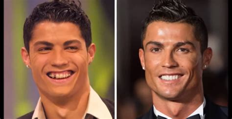 Veneers Celebrities Before And After