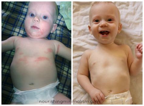 How I Cured My Infants Eczema Nourishing Minimalism