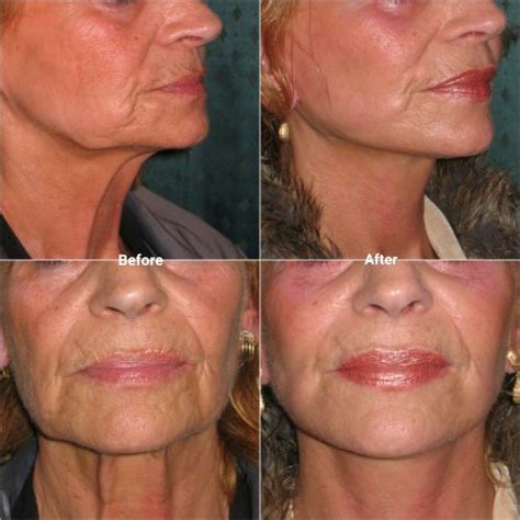 Best Procedure For Sagging Jowls 2020 Uk Raleigh Hickman