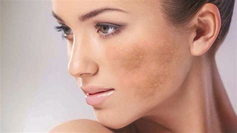 Everything You Need To Know About Melasma And Its Treatment
